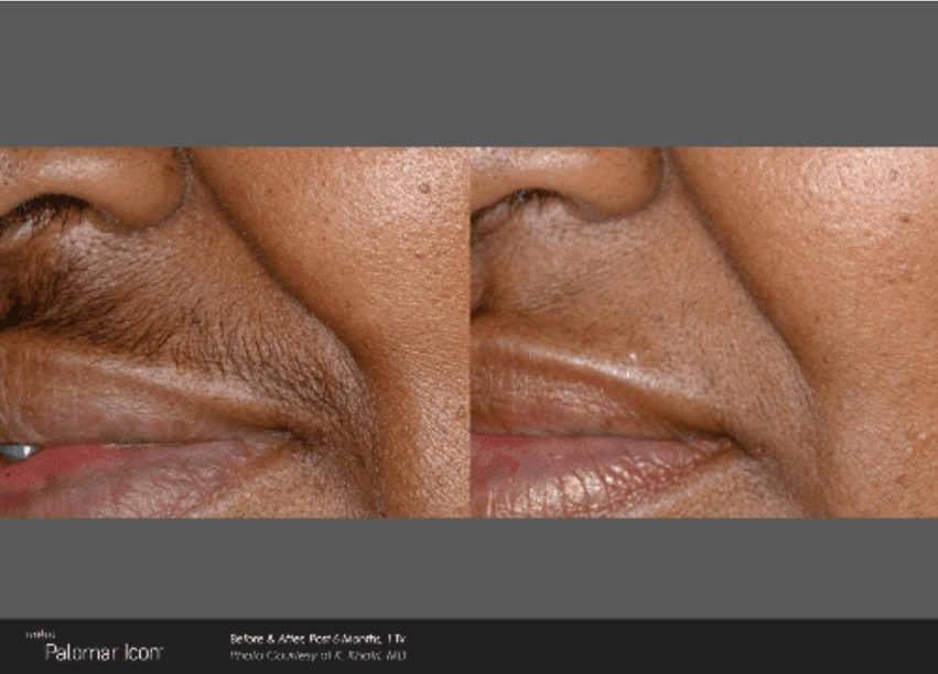 Icon Laser: Laser Hair Removal Gallery