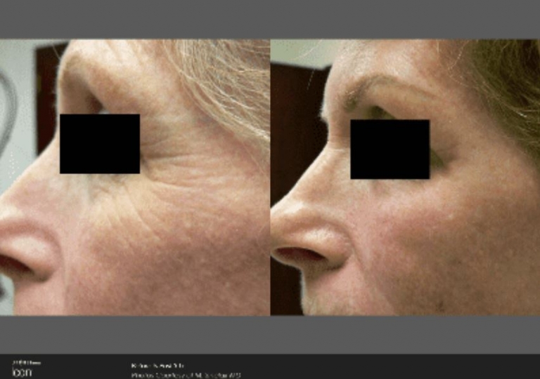 Icon Laser: Skin Rejuvenation Gallery