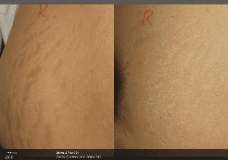 Icon Laser: Skin Rejuvenation Gallery