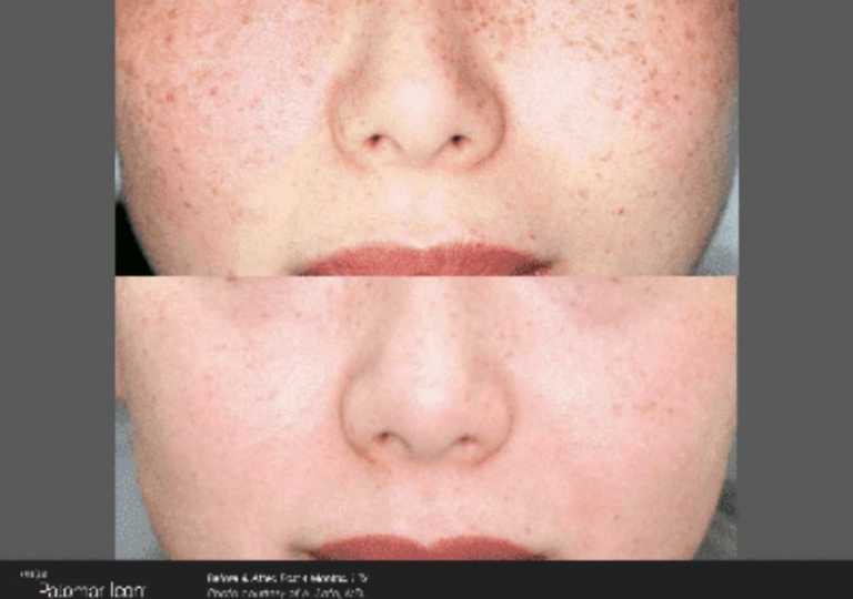 Icon Laser: Skin Rejuvenation Gallery