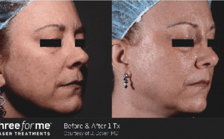 Icon Laser: ThreeForMe Gallery