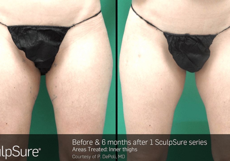 SculpSure Gallery