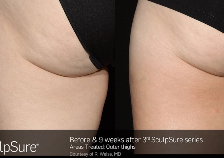 SculpSure Gallery