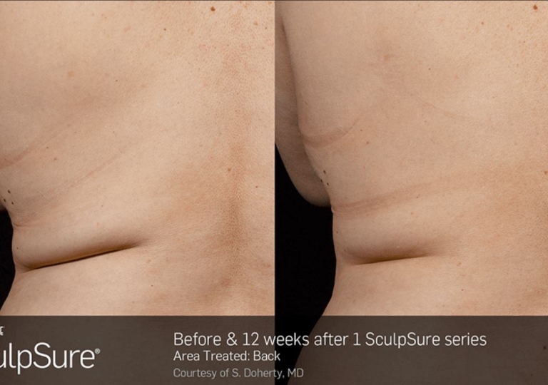 SculpSure Gallery