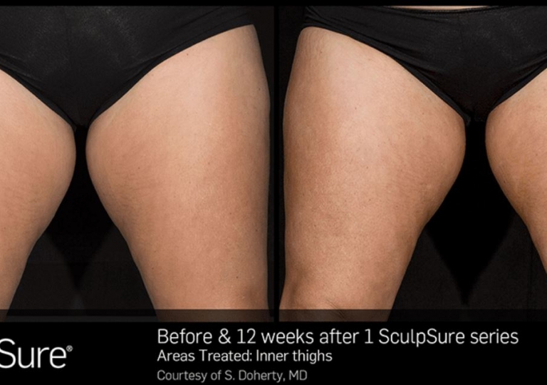 SculpSure Gallery