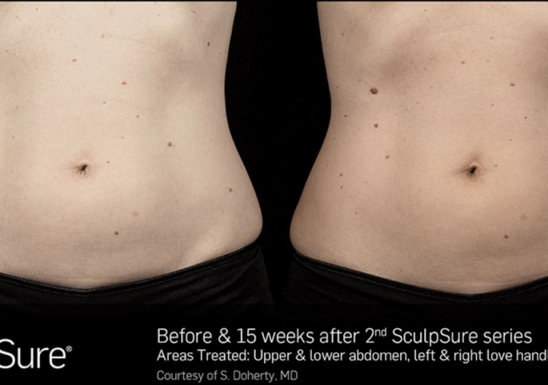 SculpSure Gallery